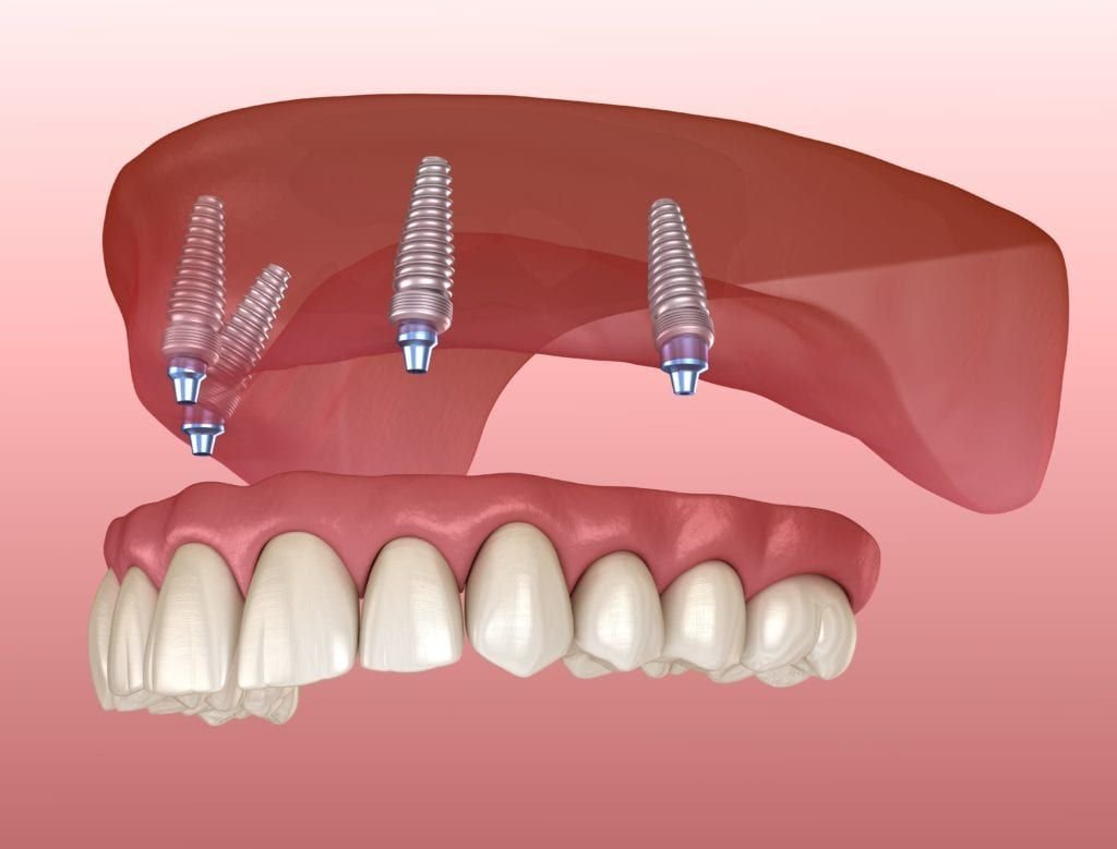 Why Implant Dentures Are the Top Choice Over Traditional Dentures – BDnews55.com